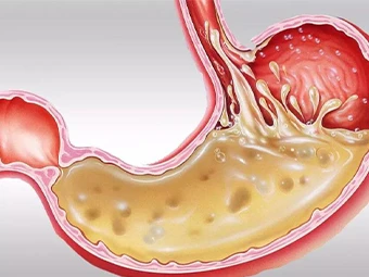 متى يمكن استخدام Proglumide؟